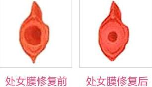 蚌埠市第三人民醫(yī)院燒傷整形科許瑾醫(yī)生做處女摸修復(fù)怎么樣？附案例