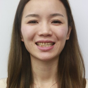 保定東陽(yáng)口腔醫(yī)院興磊醫(yī)生做牙齒貼面怎么樣？附牙齒貼面案例效果對(duì)比圖