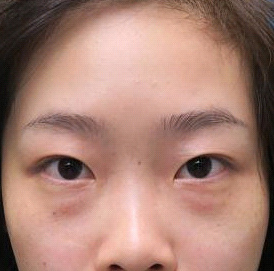 保定安卓貝拉醫(yī)療美容門診部孫大山醫(yī)生做雙眼皮+去眼袋怎么樣？附案例效果對比圖
