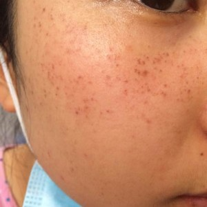 寶雞皮膚病醫(yī)院文東亮醫(yī)生做臉部祛斑效果怎么樣？附臉部祛斑案例