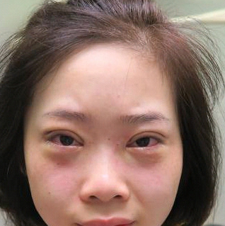 保定安卓貝拉醫(yī)療美容門診部孫大山醫(yī)生做雙眼皮+去眼袋怎么樣？附案例效果對比圖
