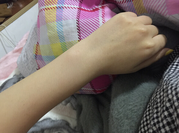 蚌埠市第三人民醫(yī)院燒傷整形科李方奇注射美白針效果怎么樣？安全嗎？附案例