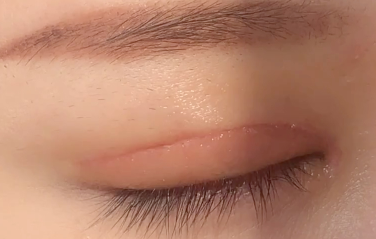 全切雙眼皮多久恢復(fù)？全切開雙眼皮有哪些優(yōu)點(diǎn)？