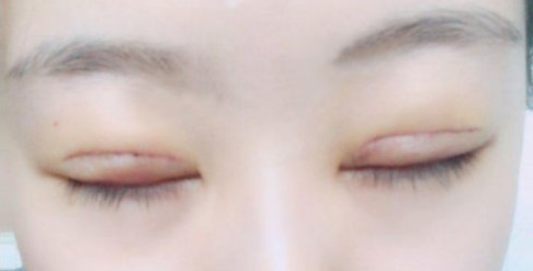全切雙眼皮術(shù)后會(huì)留疤嗎？