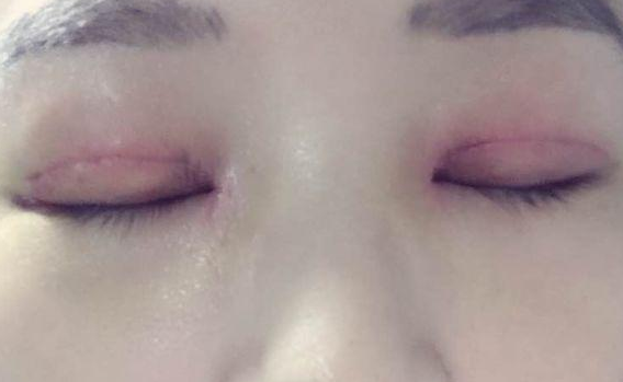 全切雙眼皮不對稱怎么辦？