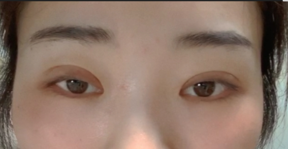 什么是全切雙眼皮？全切雙眼皮的恢復(fù)時間？