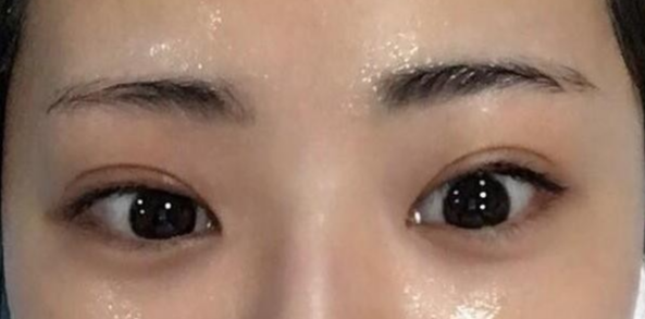 雙眼皮全切的風(fēng)險(xiǎn)有哪些？