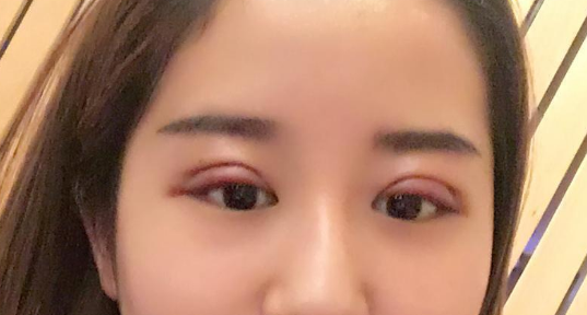 全切雙眼皮好不好？全切雙眼皮多長(zhǎng)時(shí)間恢復(fù)自然？