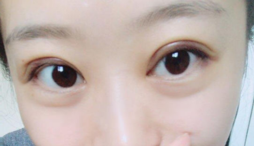 全切雙眼皮手術(shù)時間？全切雙眼皮術(shù)后會反彈嗎？