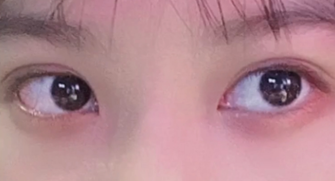 全切雙眼皮有哪些壞處？
