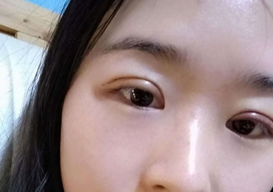 全切雙眼皮大概多少錢？全切雙眼皮多久能恢復(fù)？