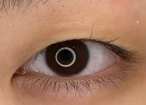 全切雙眼皮幾天可以洗臉？