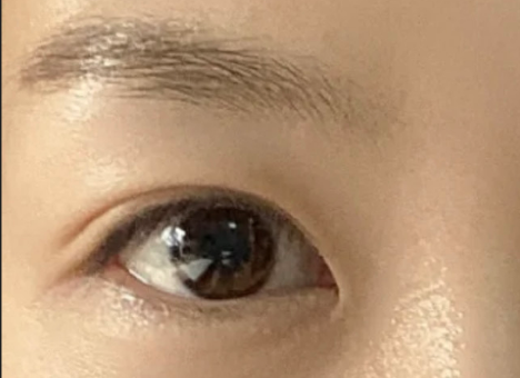 全切雙眼皮效果怎么樣？全切雙眼皮多久自然？