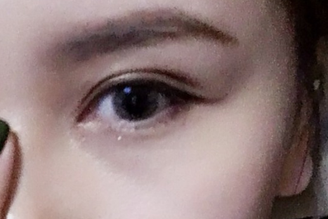 全切雙眼皮多久恢復(fù)好可以看到效果？全切雙眼皮需要多少錢？