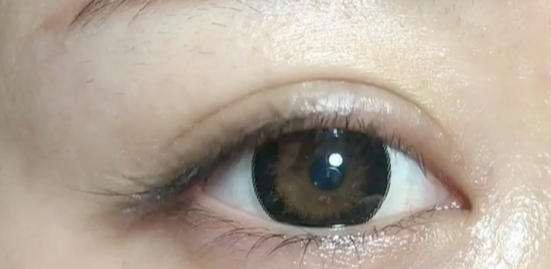 雙眼皮做埋線好還是全切好？