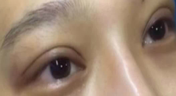 埋線雙眼皮大概能保持幾年？