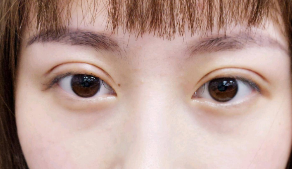 埋線雙眼皮需要拆線嗎？
