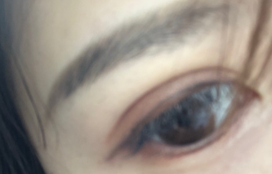 埋線雙眼皮手術優(yōu)勢有哪些？