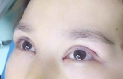 埋線雙眼皮有哪些注意事項(xiàng)？