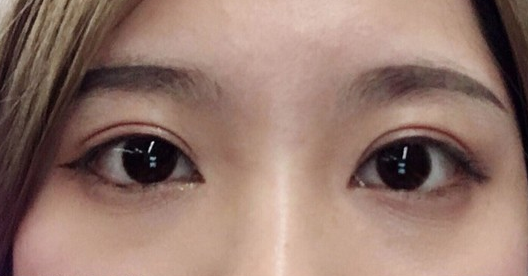 埋線雙眼皮幾天可以碰水？