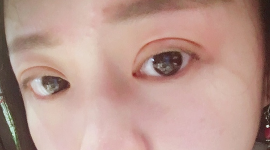 埋線雙眼皮可以保持幾年？埋線雙眼皮的危害有哪些？