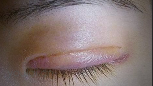 埋線雙眼皮一般會(huì)腫幾天？雙眼皮埋線好還是切開(kāi)好？