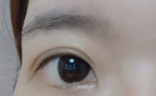 雙眼皮埋線大概多久恢復(fù)？