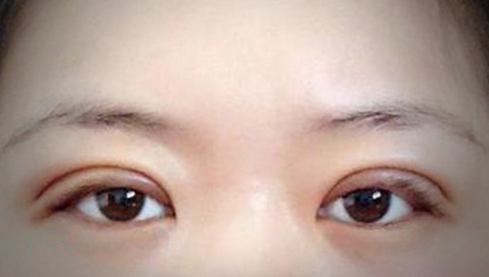 定點(diǎn)雙眼皮幾天能恢復(fù)好？定點(diǎn)做雙眼皮多少錢？