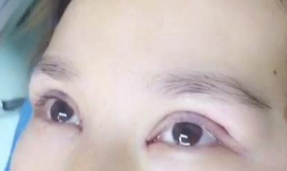 定點雙眼皮手術(shù)效果自然嗎？