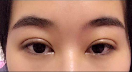 單眼皮割雙眼皮風(fēng)險(xiǎn)大嗎？