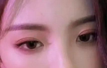 割雙眼皮會有疤痕嗎？割雙眼皮幾個月定型？