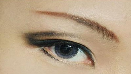 疤痕皮膚可以割雙眼皮嗎？40歲做埋線雙眼皮的效果好不好？