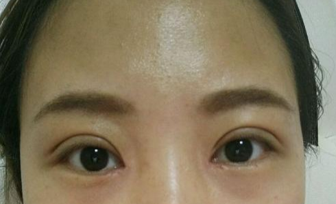 定點(diǎn)雙眼皮會(huì)腫嗎？定點(diǎn)雙眼皮會(huì)有疤痕嗎？