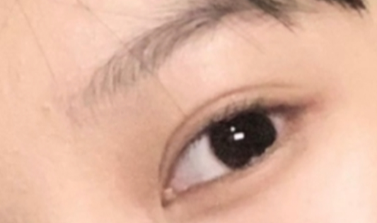 割雙眼皮恢復(fù)需要多久？