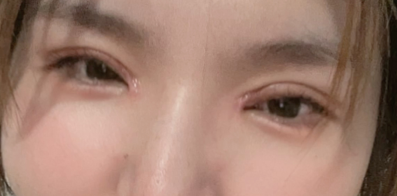 割雙眼皮后要冰敷多久？