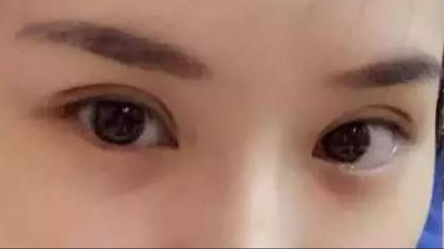 做雙眼皮對身體有沒有危害？
