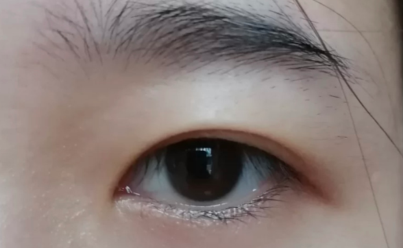 做雙眼皮拆線好還是免拆線好？