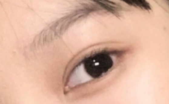 做雙眼皮效果能保持多久？做雙眼皮要冰敷多久？