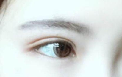 開(kāi)眼角的恢復(fù)期多長(zhǎng)？開(kāi)眼角的后遺癥都有什么？