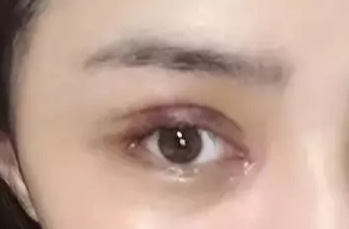 韓式開眼角失敗了怎么辦？