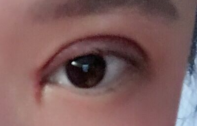 韓式開(kāi)眼角手術(shù)有哪些優(yōu)勢(shì)？
