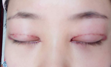 韓式開(kāi)眼角手術(shù)要花多少錢(qián)？