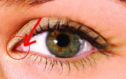 開內(nèi)眼角手術(shù)有什么效果？術(shù)后有哪些注意事項(xiàng)？