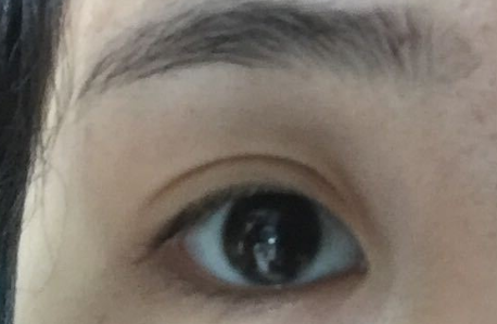 開內(nèi)眼角拆線后變化明顯嗎？開內(nèi)眼角會不會留疤？