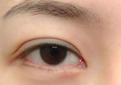 開內(nèi)外眼角多久能恢復好？開內(nèi)外眼角多少錢？