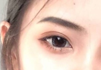 開內(nèi)外眼角的恢復(fù)期是多久？術(shù)后后遺癥有哪些？