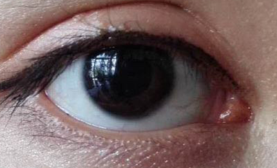 開眼角幾天能恢復(fù)？