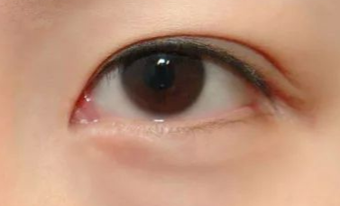 開內(nèi)眼角的優(yōu)缺點(diǎn)有哪些？