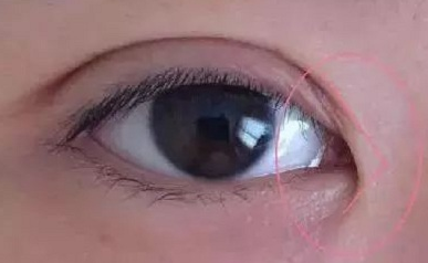 開(kāi)內(nèi)眼角的作用有哪些？開(kāi)內(nèi)眼角都會(huì)回縮嗎？