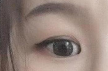 開內(nèi)眼角的手術(shù)費用多少？術(shù)后禁忌癥有哪些？